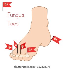 Illustration with the image of the foot and locations of spread of a fungus toes. It can be used for medical posters. Stylized illustration of fungus on flag.