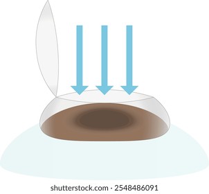 Illustration of an image of laser irradiation in vision correction surgery