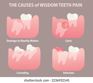 illustration of Impacted wisdom teeth, wisdom teeth pain causes - vector