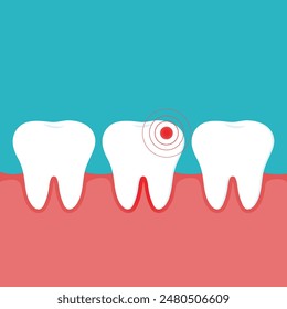 Ilustración de un diente y encía inflamados y dientes sanos. Gingivitis. Concepto para clínicas dentales y folletos de cuidado bucal.