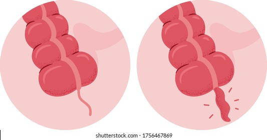 Illustration of Inflammation of the Appendix with Appendicitis and a Normal Appendix