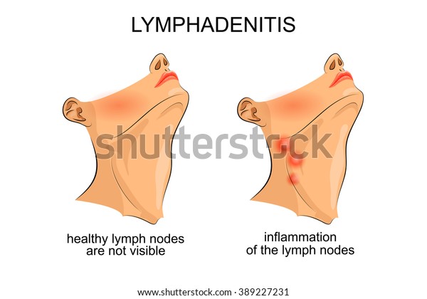 Inflamacion De Los Ganglios Linfaticos Submandibulares