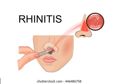 illustration of inspection of the nasal cavity
