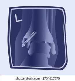 Illustration of internal ankle tibia fracture on a X-ray. Fracture repair operation.