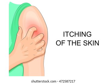 illustration itching skin infection. hand combing shoulder
