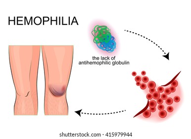 Illustration Of The Joints Of The Patient With Hemophilia. Bleeding. Injury.