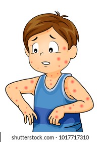 Illustration of a Kid Boy with Rashes All Over His Body from Chickenpox