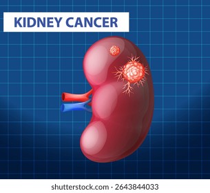 Illustration of a kidney with cancer cells, vibrant colors, medical theme, grid background, educational use