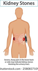 Illustration of kidney stones and associated pain