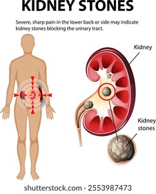 Illustration of kidney stones causing severe pain