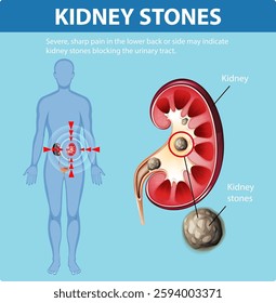 Illustration of kidney stones causing severe pain