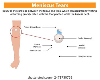 Illustration of knee anatomy and meniscus tear