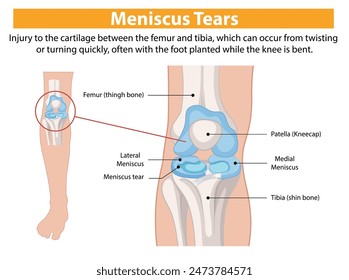 Illustration of knee meniscus tear and anatomy