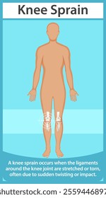 Illustration of knee sprain with highlighted ligaments