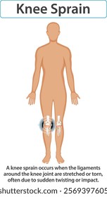 Illustration of knee sprain and ligament damage