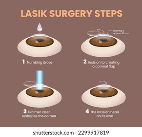 illustration of lasik eye surgery steps - vector