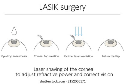 Illustration, LASIK Vision Correction, Medical Illustration.