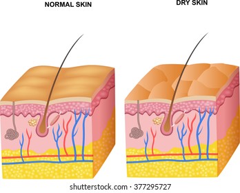 Illustration Of The Layers Normal Skin And Dry Skin