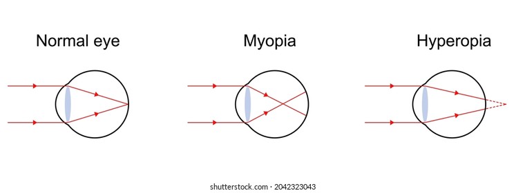 Illustration Of Light Diagram On Normal Eye, Myopia, And Hyperopia.
