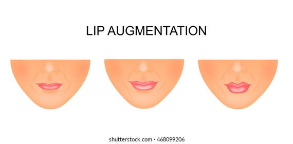 illustration of lip augmentation. before and after