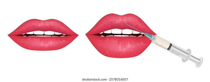 Illustration of Lip Augmentation Process. After and before Lip Filler Injection. Lips with Cosmetic Filler Syringe