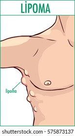 illustration of a lipoma. svg