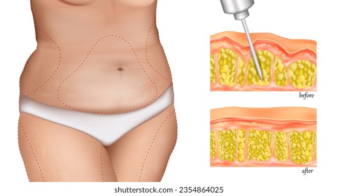 Ilustración de la intervención de liposucción en una mujer. Procedimiento de LIPOSCULTURA o LIPOMODELING. Técnica de cirugía plástica. 