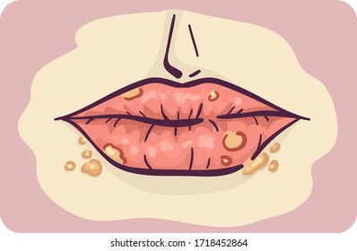 Illustration of Lips with Cold Sores Symptom of Infection