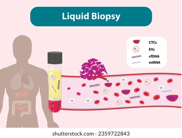Illustration of Liquid Biopsy vector, CTCs, EVs, cfDNA, miRNA