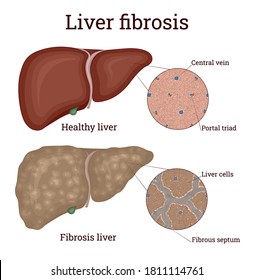 Illustration Of Liver Disease - Fibrosis, Which Is An Overgrowth Of Scar Tissue