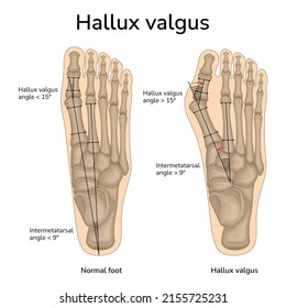 An illustration of the location of the bones in a healthy foot and hallux valgus. The angles of the bones relative to each other are indicated