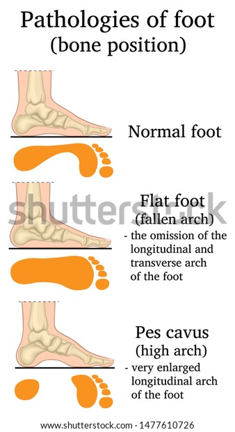 Illustration Location Bones Pathologies Foot Stock Vector (Royalty Free ...
