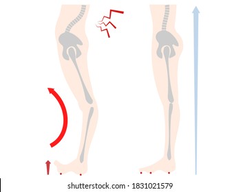 Illustration of lower body and bone distortion of floating fingers