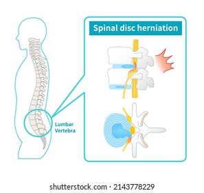 Illustration Of Lumbar Disc Herniation