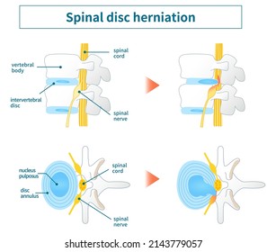 Illustration of lumbar disc herniation