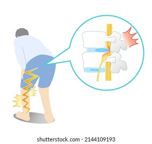 Illustration of lumbar disc herniation