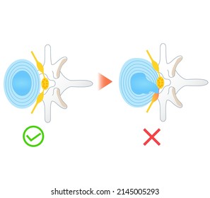 Illustration Of Lumbar Disc Herniation