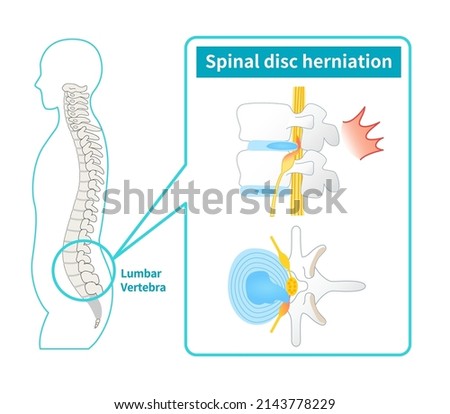 Illustration of lumbar disc herniation Stockfoto © 