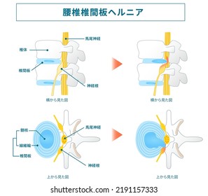 Illustration of lumbar disc herniation [Translation] cervical disc herniation, sciatic nerve, lower back, vertebrae, spine, back pain