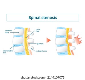 Illustration Of Lumbar Spinal Canal Stenosis