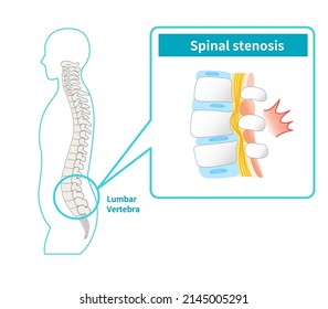 Illustration of lumbar spinal canal stenosis