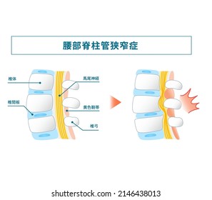 Illustration of lumbar spinal canal stenosis Translation:How Lumbar Spinal Stenosis Works