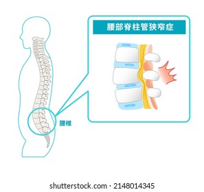 Illustration of lumbar spinal canal stenosis Translation:How Lumbar Spinal Stenosis Works