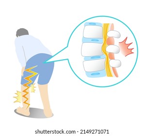 Illustration of lumbar spinal canal stenosis