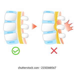 Illustration of lumbar spinal canal stenosis