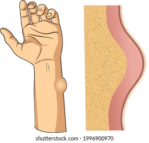 illustration of lump under the skin, Lipoma - vector