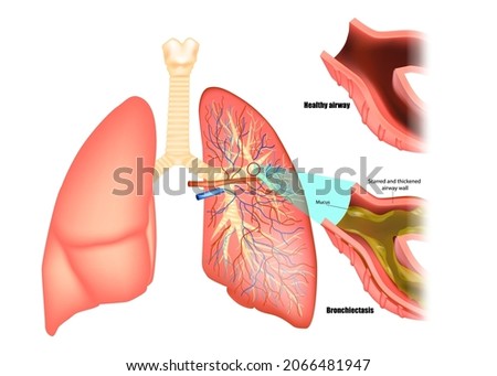 Illustration of lungs affected by bronchiectasis disease. Obstructive lung disease