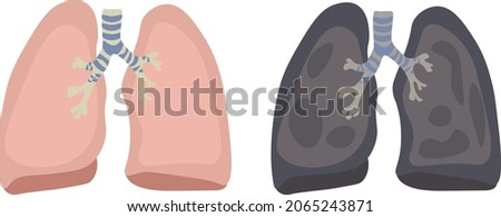 Illustration of the lungs of a healthy person and the lungs of a smoker. Prevention of the development of lung cancer. Smoking kills.