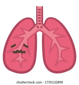 Illustration of lungs reddened by inflammation