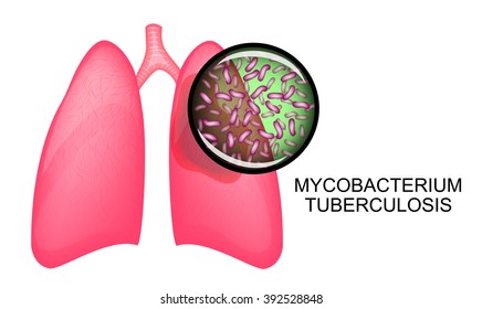 illustration of the lungs sick of a tuberculosis. Mycobacterium tuberculosis